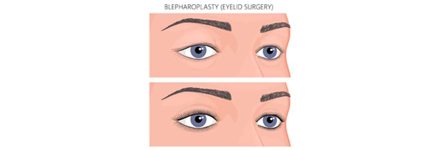 Eyelid Surgery - Canyon Speciality Surgery Center