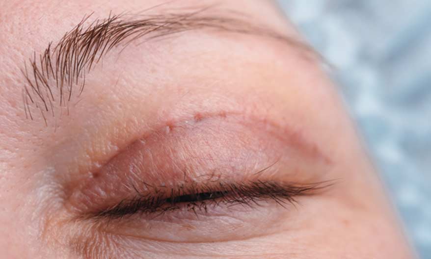 Eyelid Surgery - Canyon Speciality Surgery Center