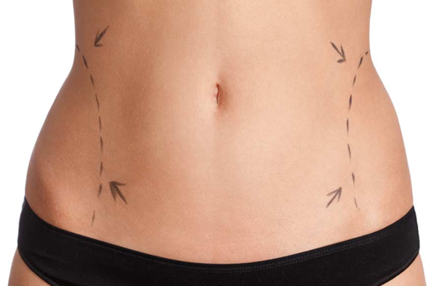 Liposuction - Canyon Speciality Surgery Center