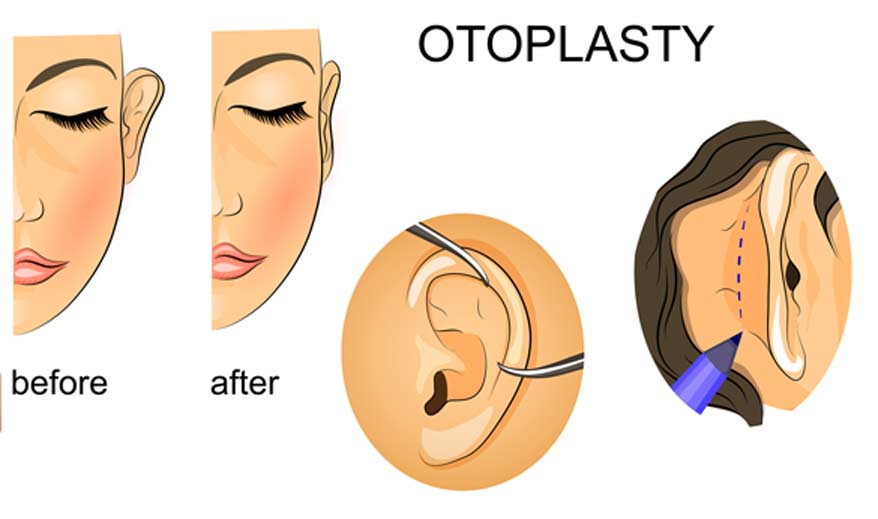 Otoplasty - Canyon Speciality Surgery Center