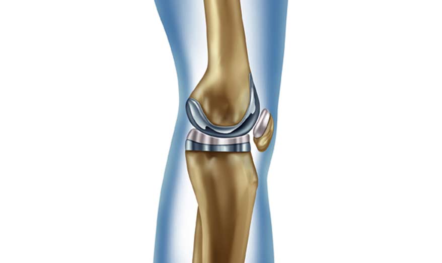 Outpatient Minimally Invasive Total Knee Replacement - Canyon Speciality Surgery Center