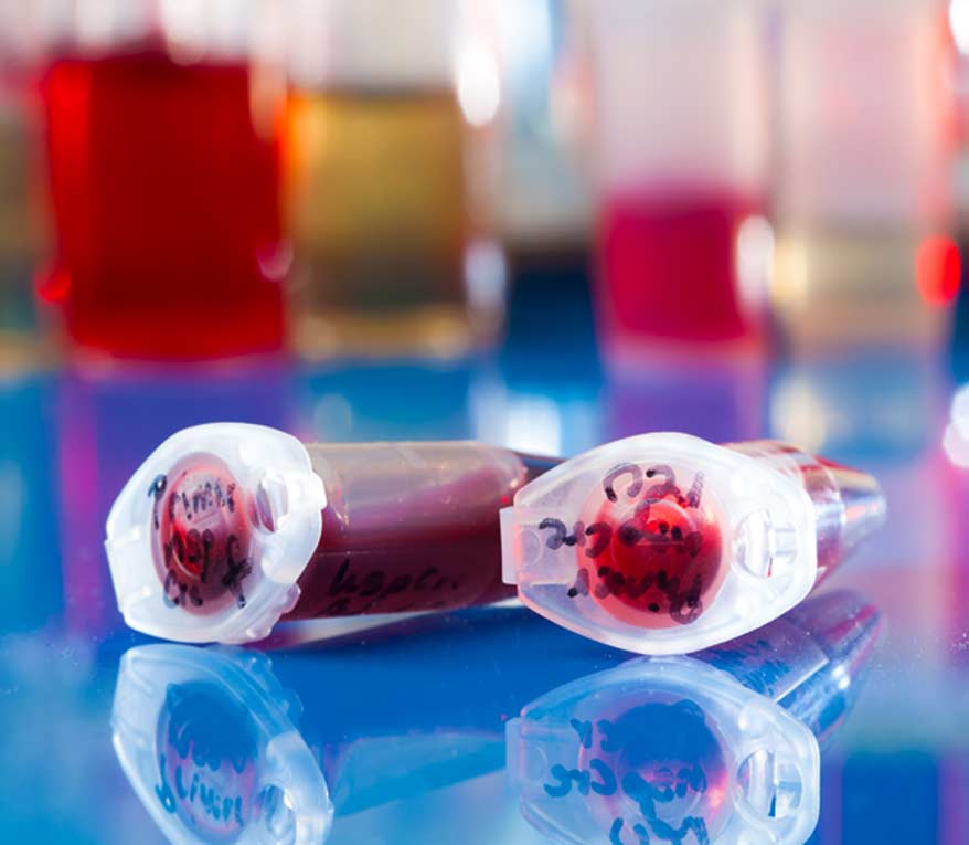 PRP Injections - Canyon Speciality Surgery Center PRP Injections - Canyon Speciality Surgery Center