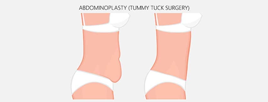 Tummy Tuck - Canyon Speciality Surgery Center