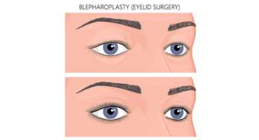 Eyelid-Surgery-Canyon-Speciality-Surgery-Center