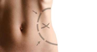 Liposuction-Canyon-Speciality-Surgery-Center