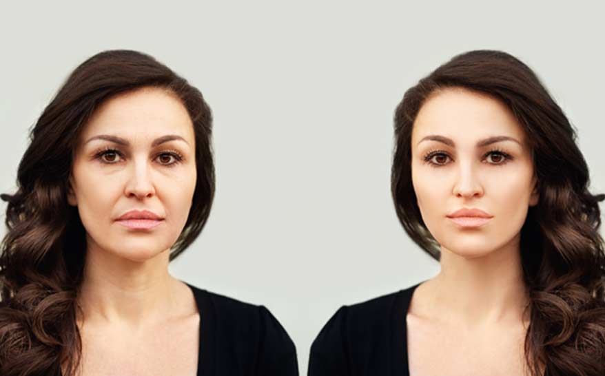 Juvederm Vollure XC - Canyon Speciality Surgery Center Juvederm Vollure XC - Canyon Speciality Surgery Center