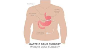 Bariatric-Surgery-Canyon-Surgery