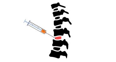 Epidural-Steroid-Therapy-Cervical-Thoracic-Lumbar-Spine