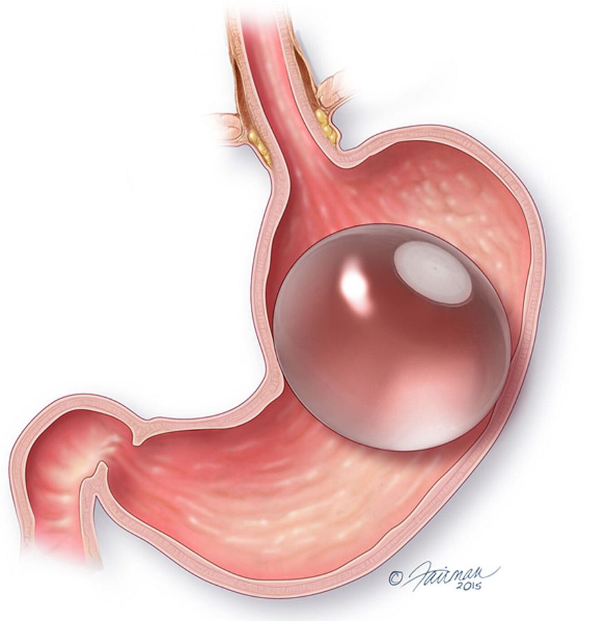 Illustration-of-Orbera-balloon-in-the-stomach